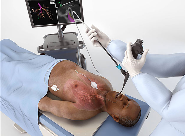 Bronchoscopy