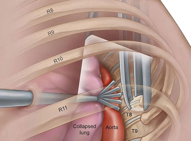 Thoracoscopy