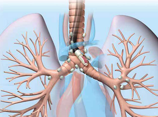 TBNA-Conventional-and-Endobronchial