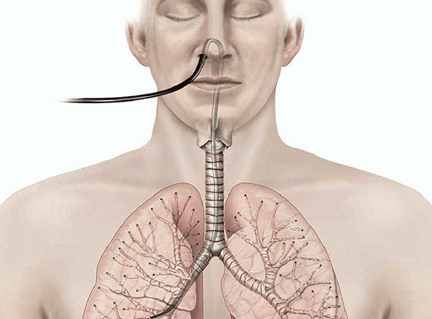 Transbronchial-Lung-Biopsy